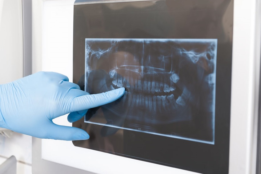 RTG RVG zęba stomatologia - Dentysta Milicz